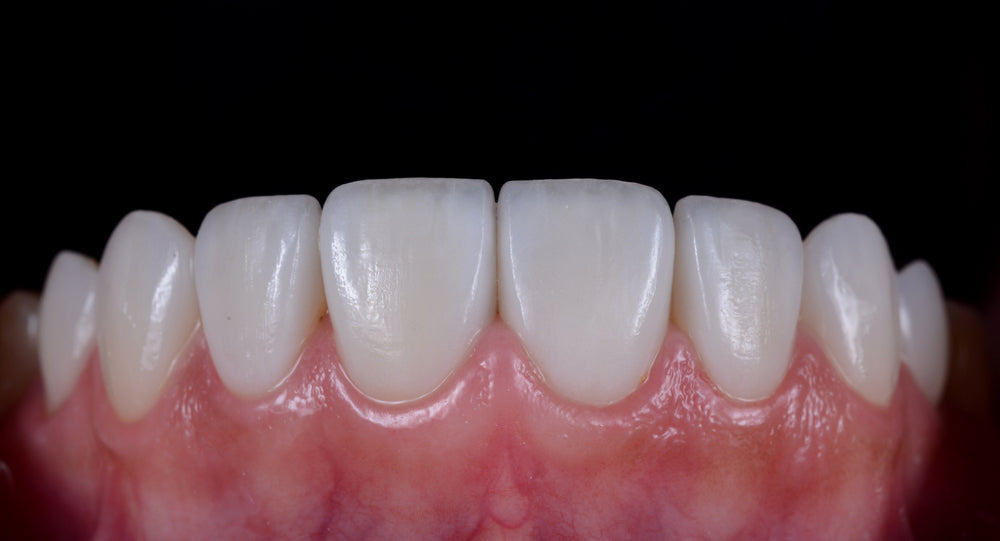 Licówka - e.max - pełny kontur