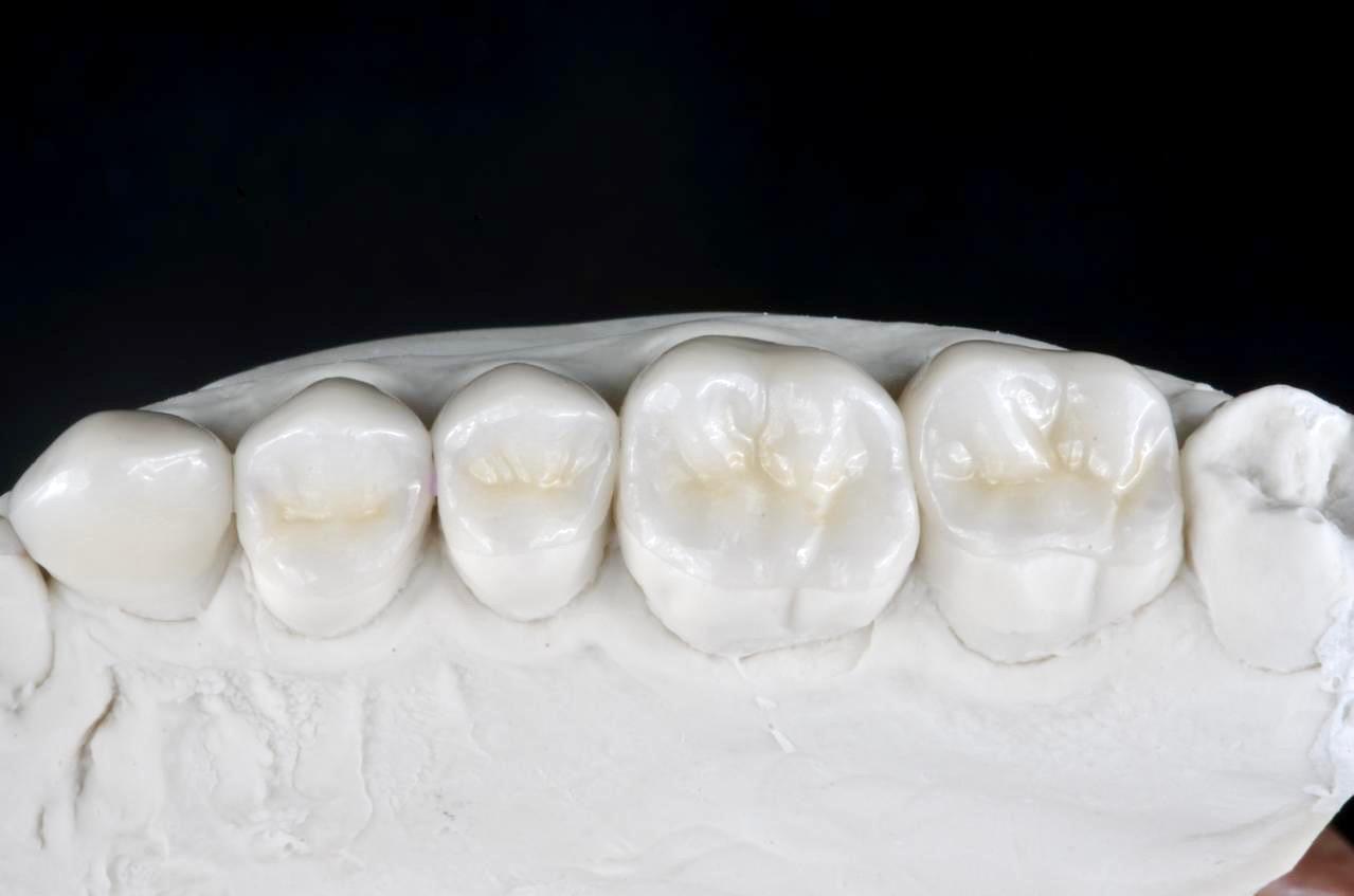 Inlay / onlay enamic