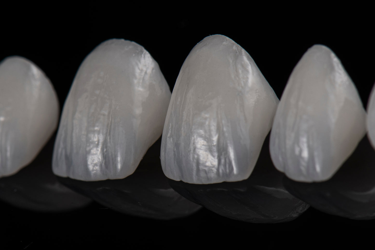 Licówka - e.max - cutback